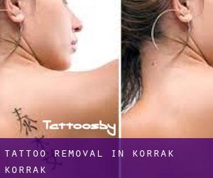 Tattoo Removal in Korrak Korrak