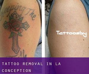 Tattoo Removal in La Conception
