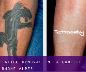 Tattoo Removal in La Gabelle (Rhône-Alpes)