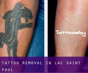 Tattoo Removal in Lac-Saint-Paul