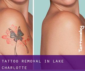 Tattoo Removal in Lake Charlotte