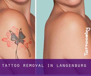 Tattoo Removal in Langenburg