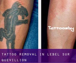 Tattoo Removal in Lebel-Sur-Quevillion