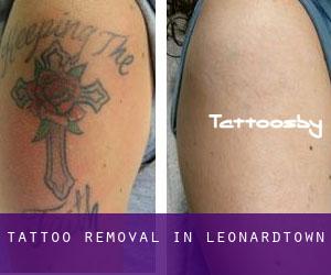 Tattoo Removal in Leonardtown