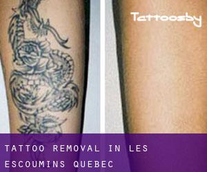 Tattoo Removal in Les Escoumins (Quebec)