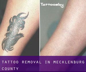 Tattoo Removal in Mecklenburg County