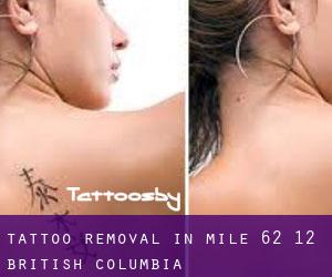 Tattoo Removal in Mile 62 1/2 (British Columbia)