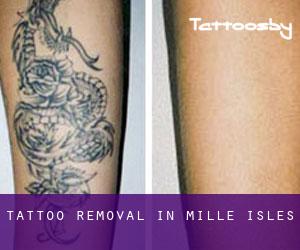 Tattoo Removal in Mille-Isles
