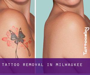 Tattoo Removal in Milwaukee
