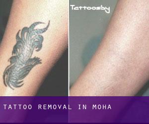Tattoo Removal in Moha