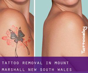 Tattoo Removal in Mount Marshall (New South Wales)