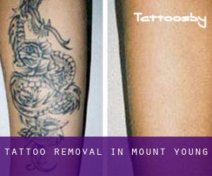Tattoo Removal in Mount Young