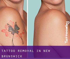 Tattoo Removal in New Brunswick