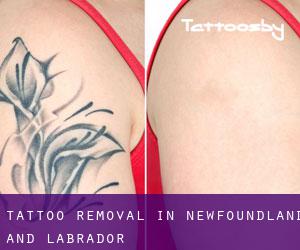 Tattoo Removal in Newfoundland and Labrador