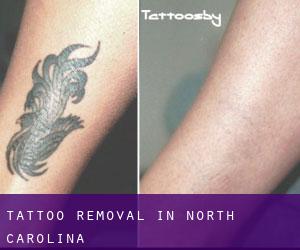Tattoo Removal in North Carolina