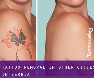 Tattoo Removal in Other Cities in Serbia