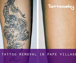 Tattoo Removal in Pape Village