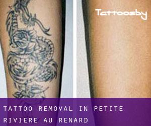Tattoo Removal in Petite-Rivière-au-Renard