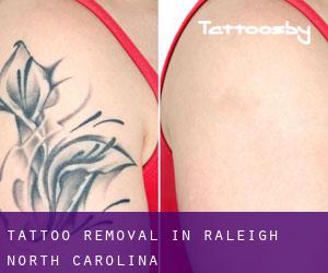 Tattoo Removal in Raleigh (North Carolina)