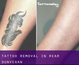 Tattoo Removal in Rear Dunvegan
