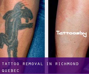 Tattoo Removal in Richmond (Quebec)
