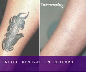 Tattoo Removal in Roxboro
