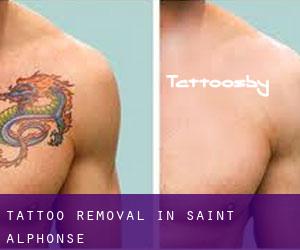 Tattoo Removal in Saint-Alphonse