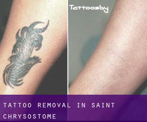 Tattoo Removal in Saint-Chrysostome