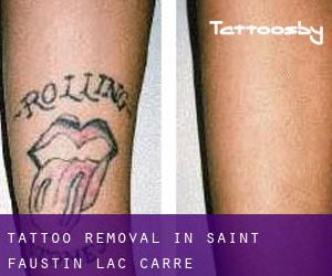 Tattoo Removal in Saint-Faustin--Lac-Carré