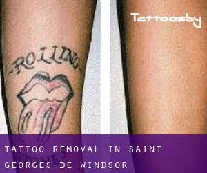 Tattoo Removal in Saint-Georges-de-Windsor