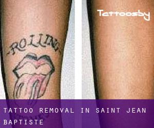 Tattoo Removal in Saint-Jean-Baptiste