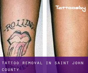 Tattoo Removal in Saint John County