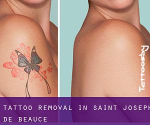 Tattoo Removal in Saint-Joseph-de-Beauce