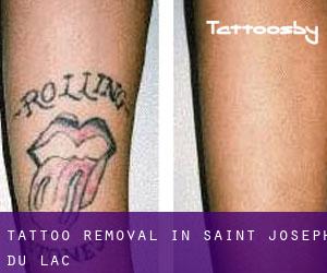 Tattoo Removal in Saint-Joseph-du-Lac