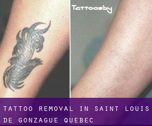 Tattoo Removal in Saint-Louis-de-Gonzague (Quebec)