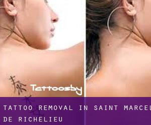 Tattoo Removal in Saint-Marcel-de-Richelieu
