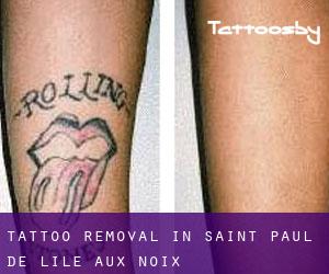 Tattoo Removal in Saint-Paul-de-l'Île-aux-Noix