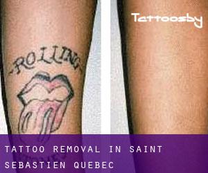 Tattoo Removal in Saint-Sébastien (Quebec)