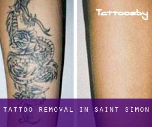 Tattoo Removal in Saint-Simon