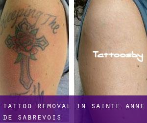 Tattoo Removal in Sainte-Anne-de-Sabrevois