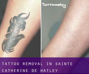 Tattoo Removal in Sainte-Catherine-de-Hatley