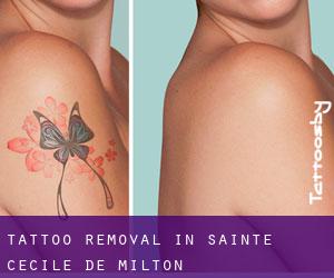 Tattoo Removal in Sainte-Cécile-de-Milton
