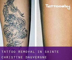 Tattoo Removal in Sainte-Christine-d'Auvergne