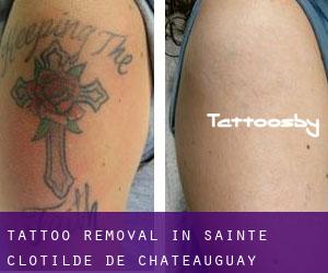 Tattoo Removal in Sainte-Clotilde-de-Châteauguay