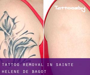 Tattoo Removal in Sainte-Hélène-de-Bagot