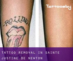 Tattoo Removal in Sainte-Justine-de-Newton