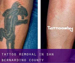 Tattoo Removal in San Bernardino County