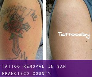 Tattoo Removal in San Francisco County