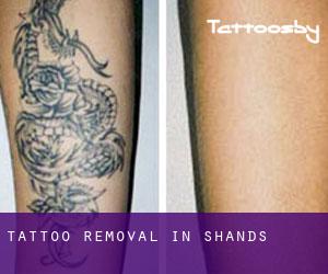 Tattoo Removal in Shands