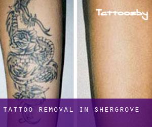 Tattoo Removal in Shergrove